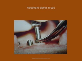 Abutment clamp in use
www.indiandentalacademy.com
 