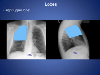 Lobes Right upper lobe: Right middle lobe: Right lower lobe: Left lower lobe: Left upper lobe with Lingula:Lingula: Left upper lobe - upper division:Abnormal Chest X-rayRadiopacity (whiteness) = increased densityRadiotranslucency (blackness) = decreased density