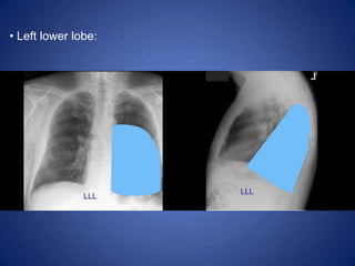Alveolar space filled with inflammatory exudate