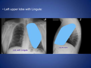 Interstitium and architecture remain intact