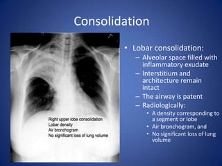 No significant loss of lung volumeConsolidation