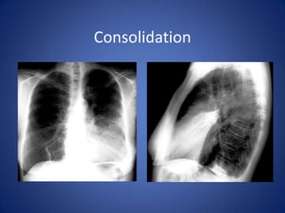 AtelectasisLoss of airObstructive atelectasis:No ventilation to the lobe beyond obstructionRadiologically:Density corresponding to a segment or lobeSignificant loss of volumeCompensatory hyperinflation of normal lungs