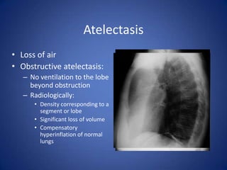 No ventilation to lobe beyond the obstructionTrapped air absorbed by pulmonary circulationSegmental/lobar densityCompensatory hyper-inflation of normal lungs.Atelectasis
