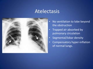 Congestive Heart FailureIncreased heart size: cardiothoracic ratio >0.5Large hila with indistinct markings
