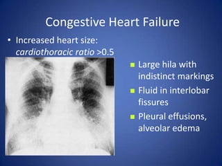 Fluid in interlobar fissures