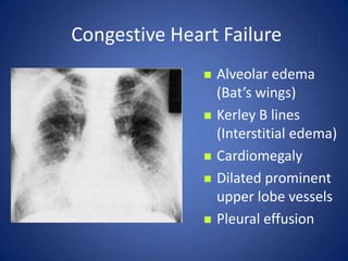 Pleural effusions, alveolar edemaCongestive Heart FailureAlveolar edema (Bat’s wings)