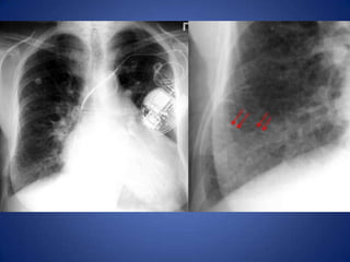 Kerley B lines (Interstitial edema)