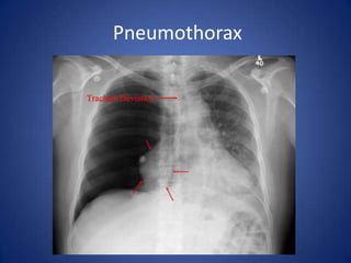 Dilated prominent upper lobe vessels