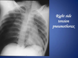 Pleural effusion
