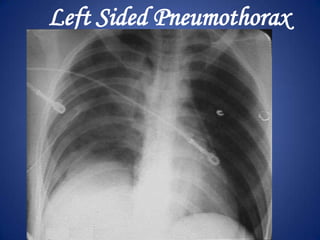 ARDSCongestionInterstitial and alveolar edemaCollapsed or distended alveoliBilateral