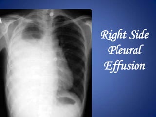 Right side tension pneumothorax
