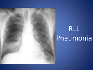 Left Sided Pneumothorax