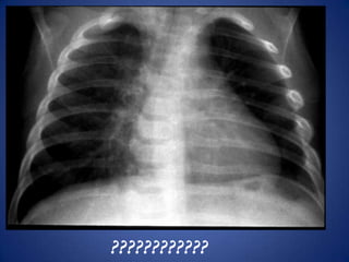 Pleural effusion