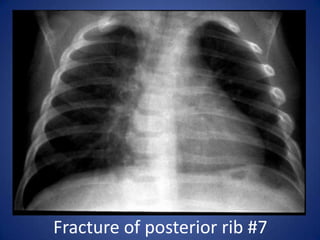 Right Side Pleural Effusion