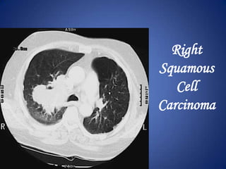 Fracture of posterior rib #7