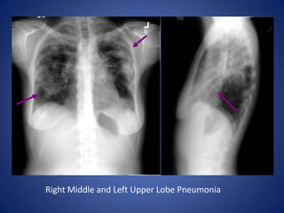 A single, 3cm relatively thin-walled cavity is noted in the left midlung. This finding is most typical of squamous cell carcinoma (SCC). One-third of SCC masses show cavitation