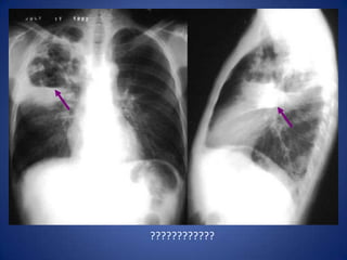 Right Squamous Cell Carcinoma