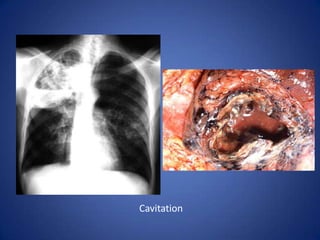 Right Middle and Left Upper Lobe Pneumonia