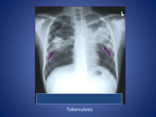 Cavitation : cystic changes in the area of consolidation due to the bacterial destruction of lung tissue. Notice air fluid level.