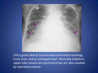 COPD: increase in heart diameter, flattening of the diaphragm, and increase in the size of the retrosternal air space. In addition the upper lobes will become hyperlucent due to destruction of the lung tissue.
