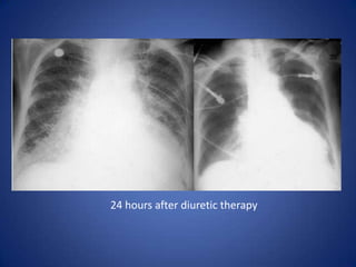 Chronic emphysema effect on the lungs