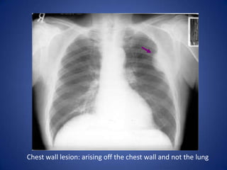 CHF:a great deal of accentuated interstitial markings, Curly lines, and an enlarged heart. Normally indistinct upper lobe vessels are prominent but are also masked by interstitial edema.