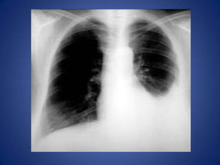 24 hours after diuretic therapy