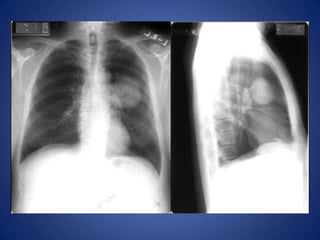 Chest wall lesion: arising off the chest wall and not the lung