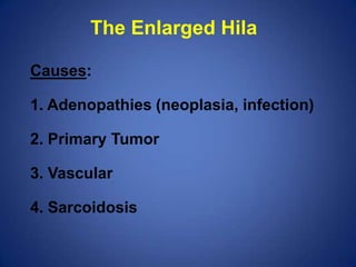 Pleural effusion: Note loss of left hemidiaphragm. Fluid drained via thoracentesis