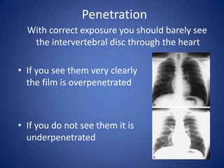 Penetration   With correct exposure you should barely see the intervertebral disc through the heartIf you see them very clearly the film is overpenetratedIf you do not see them it is underpenetrated