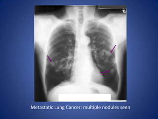 Right Middle Lobe Pneumothorax: complete lobar collapse