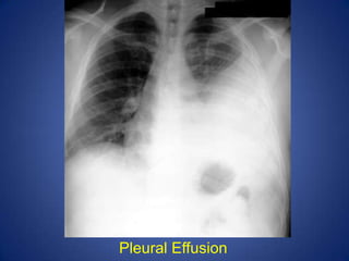 Metastatic Lung Cancer: multiple nodules seen