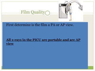 Film Quality
 First determine is the film a PA or AP view.
All x-rays in the PICU are portable and are AP
view
 