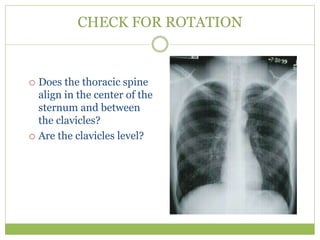 CHECK FOR ROTATION
 Does the thoracic spine
align in the center of the
sternum and between
the clavicles?
 Are the clavicles level?
 