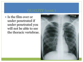 QUALITY (cont.)
 Is the film over or
under penetrated if
under penetrated you
will not be able to see
the thoracic vertebrae.
 