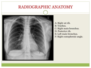 RADIOGRAPHIC ANATOMY
A: Right 1st rib.
B: Trachea.
C: Right main bronchus.
D: Posterior rib.
E: Left main bronchus.
F: Right costophrenic angle.
 