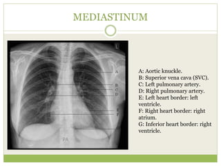 MEDIASTINUM
A: Aortic knuckle.
B: Superior vena cava (SVC).
C: Left pulmonary artery.
D: Right pulmonary artery.
E: Left heart border: left
ventricle.
F: Right heart border: right
atrium.
G: Inferior heart border: right
ventricle.
 