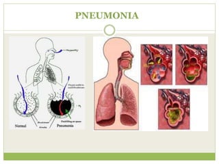 PNEUMONIA
 