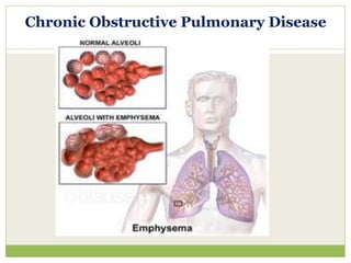 Chronic Obstructive Pulmonary Disease
 