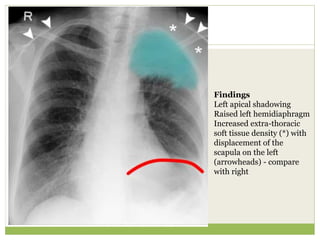 Findings
Left apical shadowing
Raised left hemidiaphragm
Increased extra-thoracic
soft tissue density (*) with
displacement of the
scapula on the left
(arrowheads) - compare
with right
 