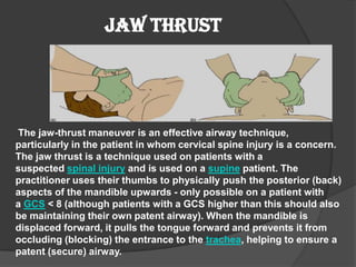 JAW THRUST




The jaw-thrust maneuver is an effective airway technique,
particularly in the patient in whom cervical spine injury is a concern.
The jaw thrust is a technique used on patients with a
suspected spinal injury and is used on a supine patient. The
practitioner uses their thumbs to physically push the posterior (back)
aspects of the mandible upwards - only possible on a patient with
a GCS < 8 (although patients with a GCS higher than this should also
be maintaining their own patent airway). When the mandible is
displaced forward, it pulls the tongue forward and prevents it from
occluding (blocking) the entrance to the trachea, helping to ensure a
patent (secure) airway.
 