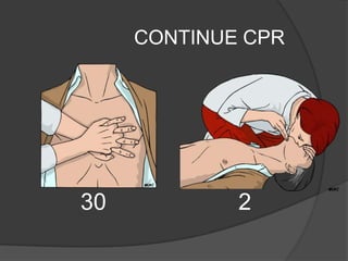 CONTINUE CPR




30           2
 