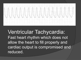 Ventricular Tachycardia:
Fast heart rhythm which does not
allow the heart to fill properly and
cardiac output is compromised and
reduced.
 