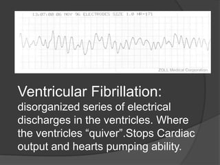 Ventricular Fibrillation:
disorganized series of electrical
discharges in the ventricles. Where
the ventricles “quiver”.Stops Cardiac
output and hearts pumping ability.
 