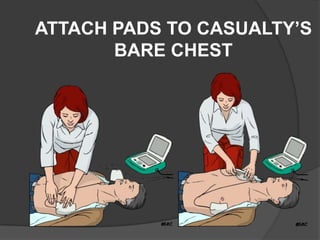 ATTACH PADS TO CASUALTY’S
       BARE CHEST
 