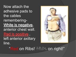 Now attach the
adhesive pads to
the cables
remembering-
White is negative,
anterior chest wall.
Red is positive ,
left anterior axillary
line.
   “Red on Ribs! White on right!”
 