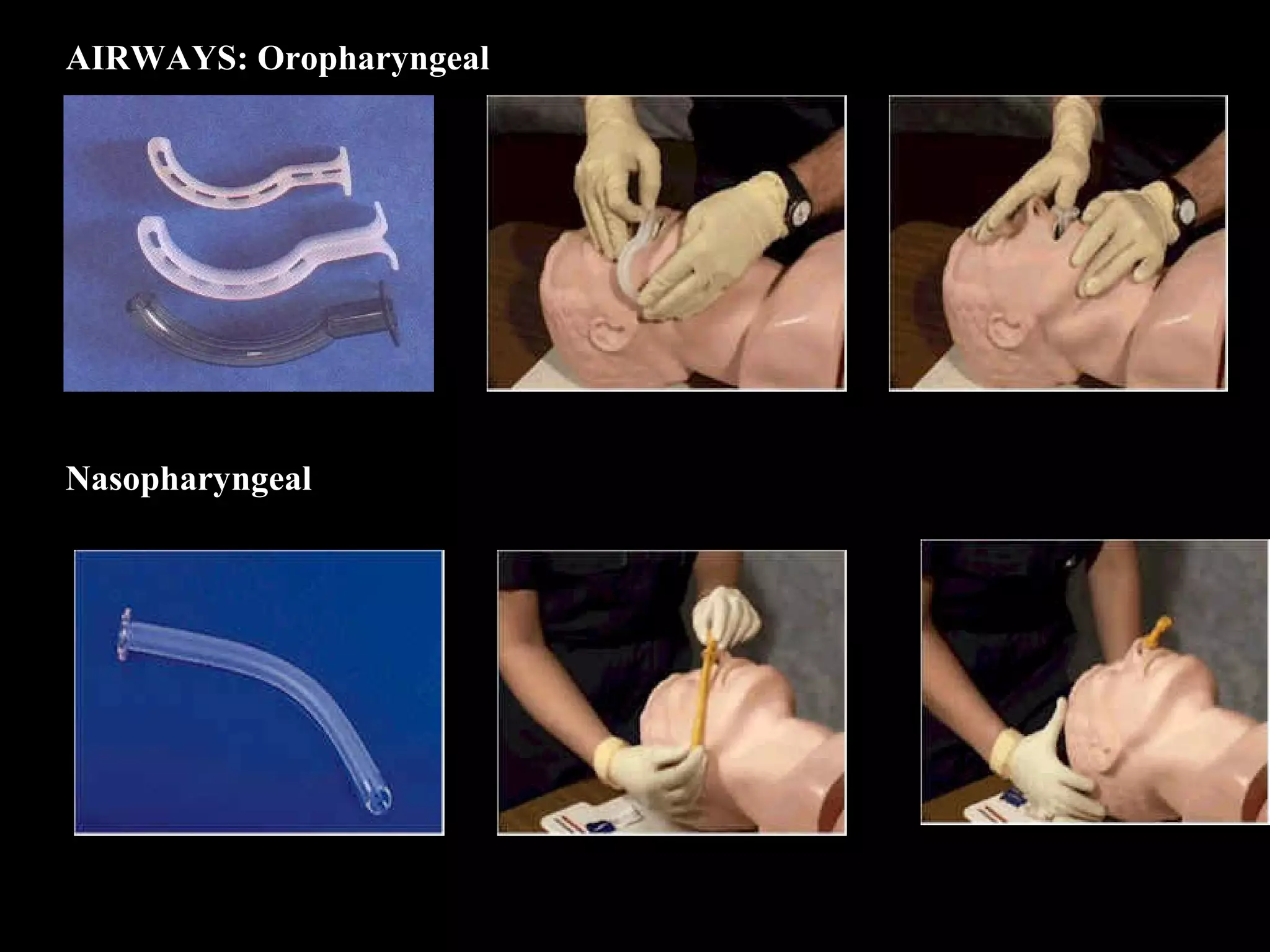 AIRWAYS: Oropharyngeal 
Nasopharyngeal 
 