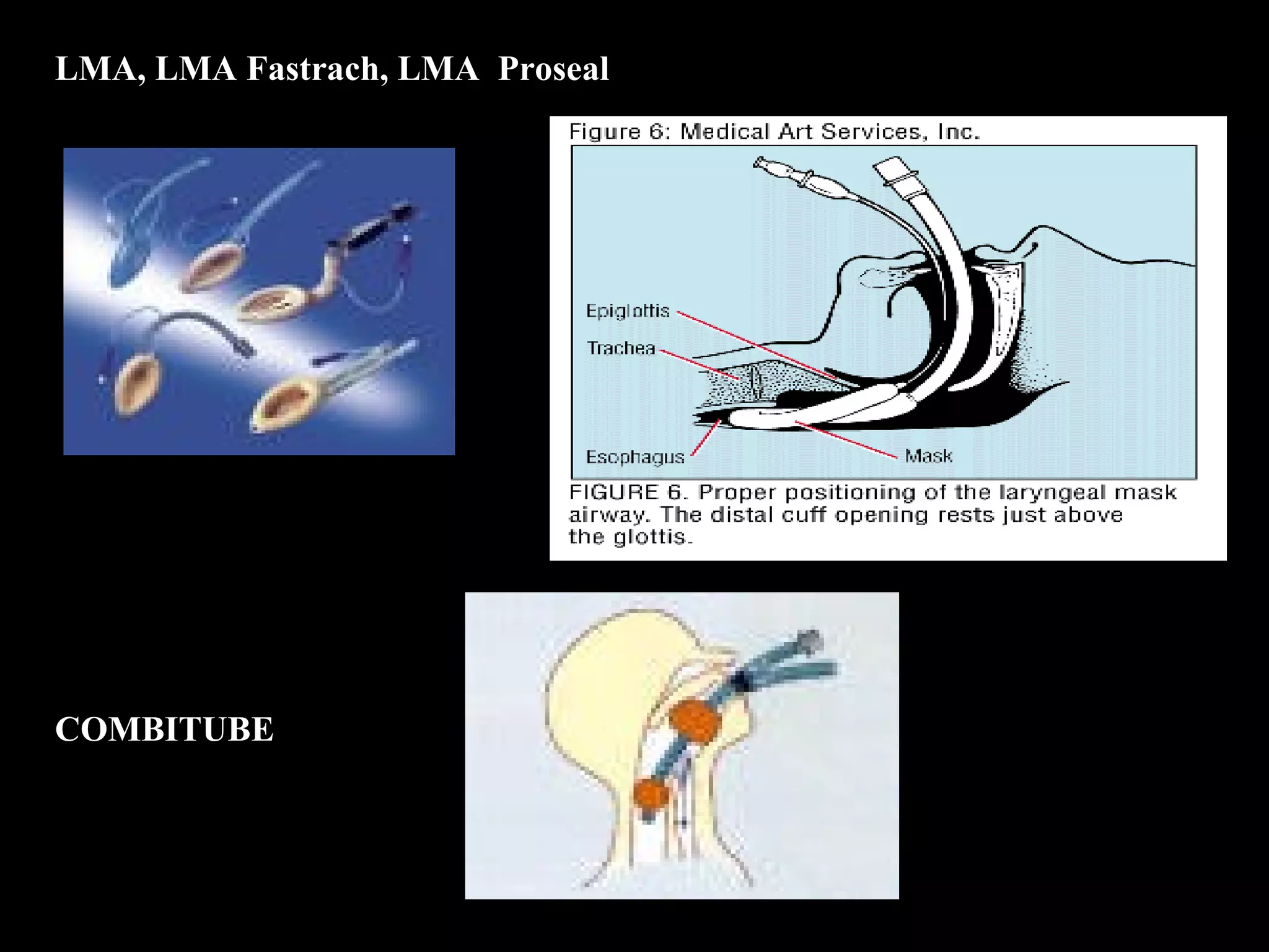 LMA, LMA Fastrach, LMA Proseal 
COMBITUBE 
 