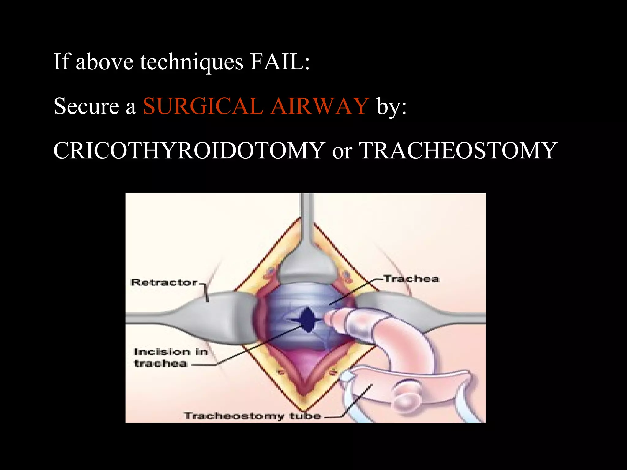 If above techniques FAIL: 
Secure a SURGICAL AIRWAY by: 
CRICOTHYROIDOTOMY or TRACHEOSTOMY 
 