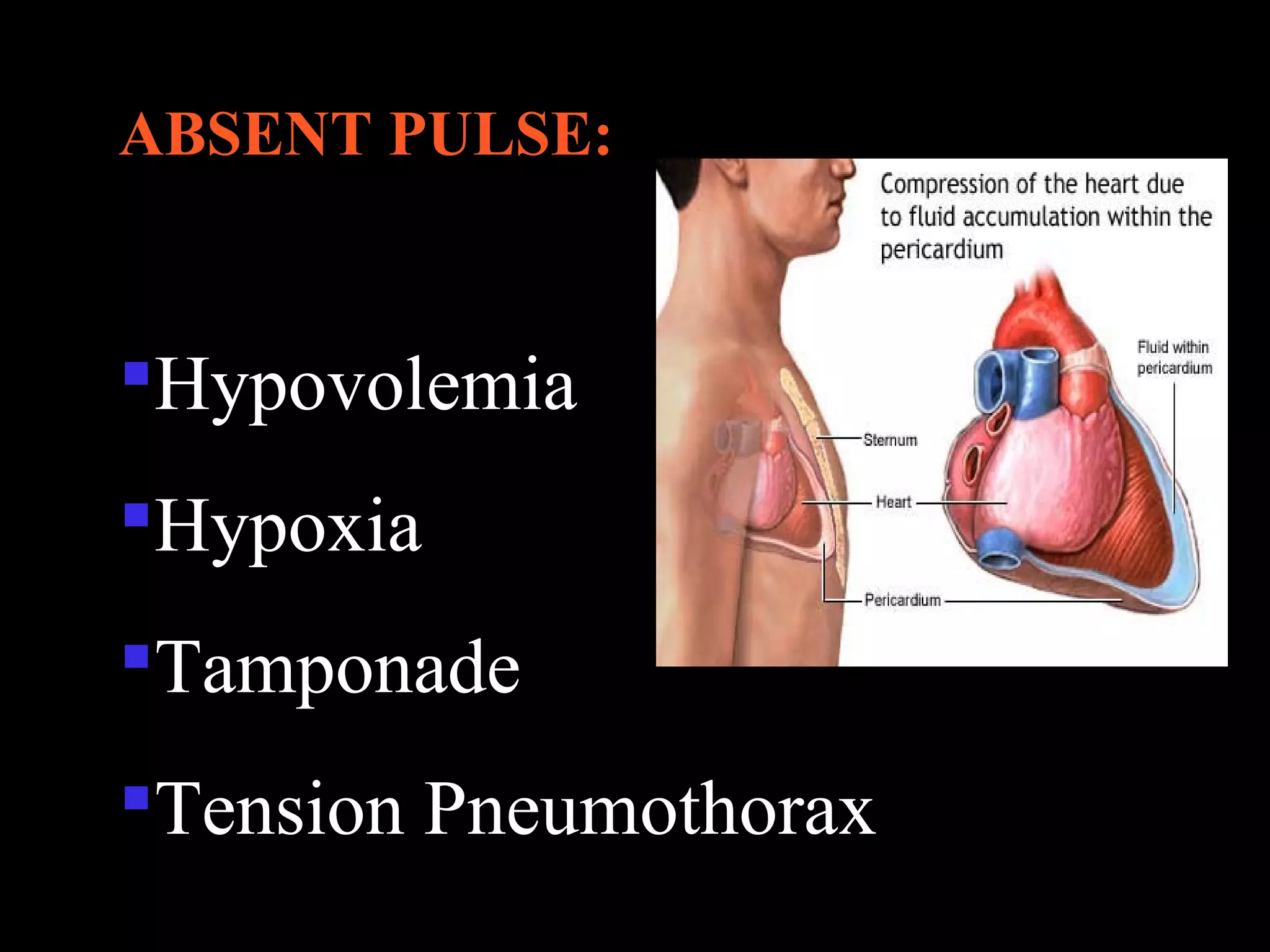 ABSENT PULSE: 
Hypovolemia 
Hypoxia 
Tamponade 
Tension Pneumothorax 
 